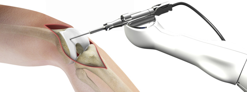 robotic knee replacement photo
